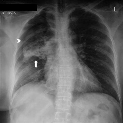 Pneumothorax Occurring After Nasogastric Tube Removal Vrogue Co