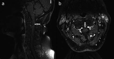 Retrodental Synovial Cyst Mri Findings Bmj Case Reports