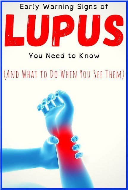 2 13 Early Warning Signs Of Lupus You Need To Know And What To Do