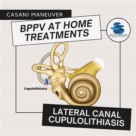 Equilibrium Physical Therapy Bppv At Home Treatment For Lateral