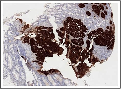 Diffusely P16 Positive Specimen Consistent With Squamous Cell Carcinoma