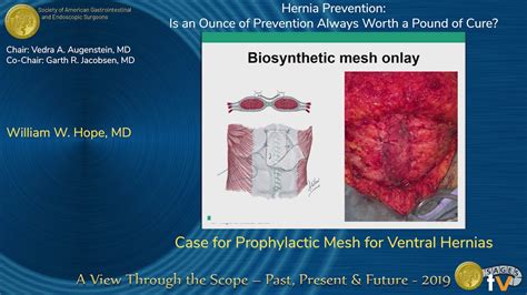 Case For Prophylactic Mesh For Ventral Hernias Youtube