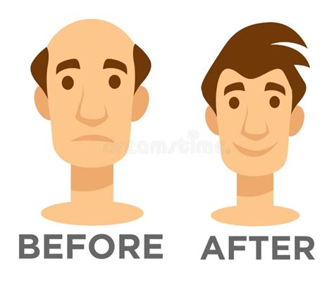 Hair Transplantation Before And After Effect Bald Man Stock Vector Illustration Of Alopecia