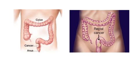What Is Rectal Cancer Symptoms And Causes