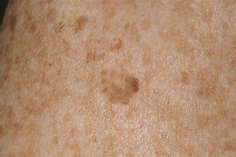 Textbook Of Skin Cancer And Melanoma