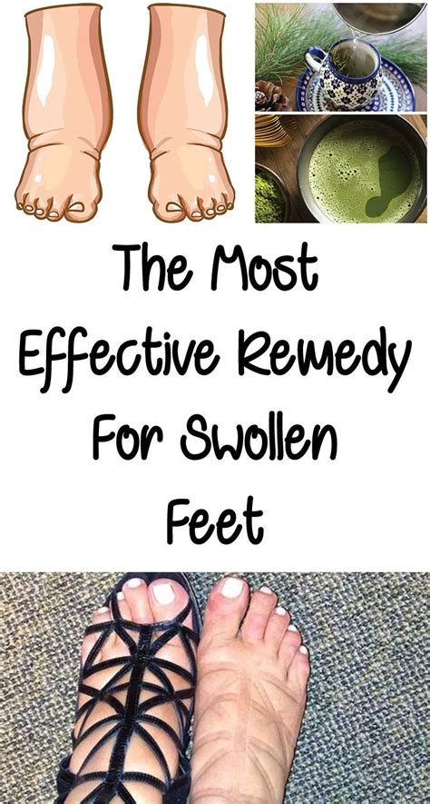 Pin On Swollen Feet Remedies