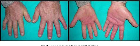 Figure 3 From Unusual Both Hands Cryogenic Burn Caused By Freon Gas And