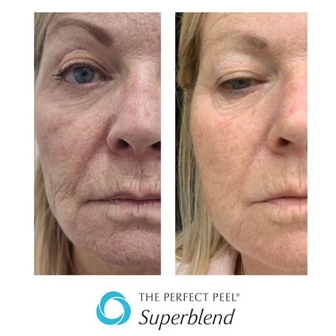 The Perfect Peel® Superblend Renew Medical Aesthetics Cheshire Clinic