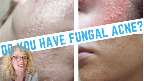2023 Update How To Clear Fungal Acne Natural Methods The Ultimate
