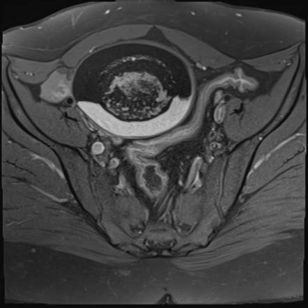 Mature Cystic Ovarian Teratoma Radiology Case Radiopaedia Org
