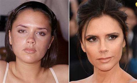 Victoria Beckham Plastic Surgery Boobs Boob Job Botox And Nose Job