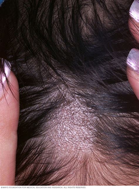 Ringworm Scalp Disease Reference Guide