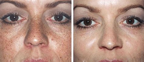 Freckle Removal How To Get Rid Of Freckles Perfection Cosmetics