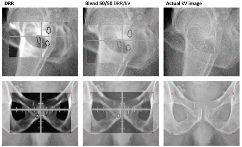 enabling state of the art radiotherapy gold anchor