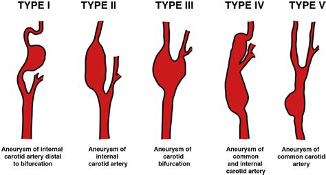 Asymptomatic Internal Carotid Aneurysm An Uncommon Disease Of The