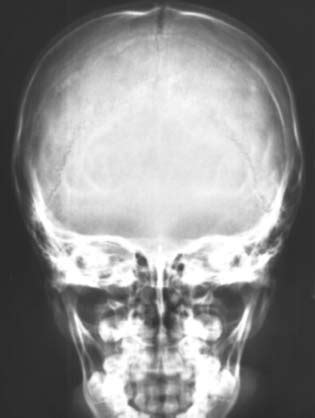 Ap axial skull ( townes projection ). Skull 3 year old (Anterior-Posterior) - NU-FSOM X-Ray Program