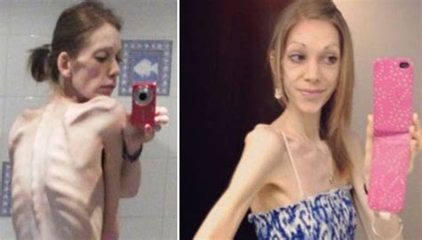 On The Brink Of Death Anorexic Teen Weighed 55lb But Bodyb