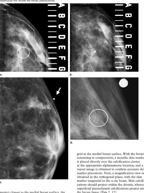 Figure 12 From Distinguishing Breast Skin Lesions From Superficial