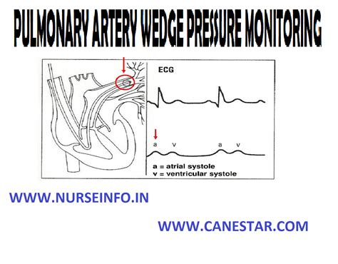 Pulmonary Artery Wedge Nurse Info
