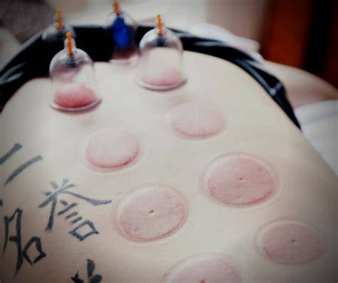 Cupping Therapy What Is It