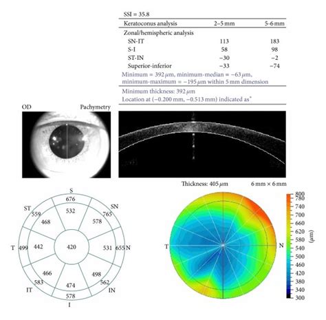Corneal Pachymetry Of A Patient With Keratoconus Generated By The A