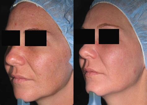 Microdermabration The Outcome Is All That Counts Laser Health Body Slim