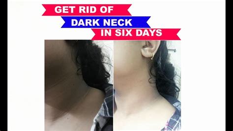 How To Get Rid Of Dark Neck In 6 Days How To Get Rid Diy Beauty