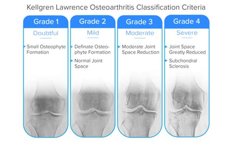 Osteoarthritis Grading Criteria Kellegren Lawrence Spring Loaded