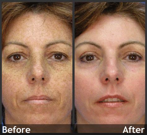 Ipl Laser Treatment Before And After Sun Damage Removal Flickr