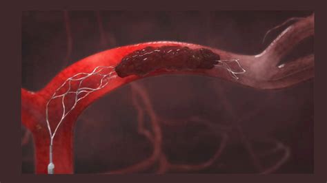 Cardiovascular Systems And Innova Vascular Partner On Thrombectomy