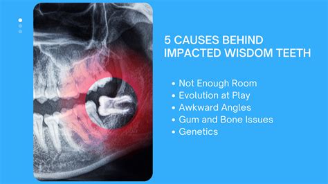 Impacted Wisdom Teeth Symptoms And Treatment Options