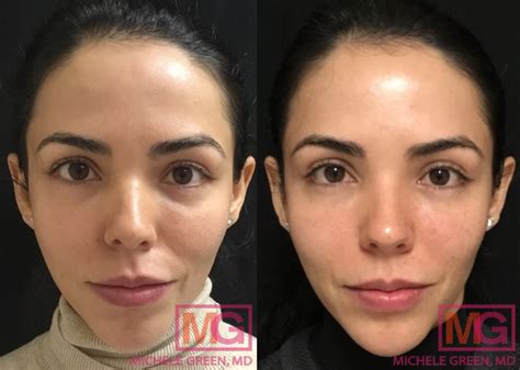 Juvederm Under Eyes Nyc Injectable Fillers Under Eyes