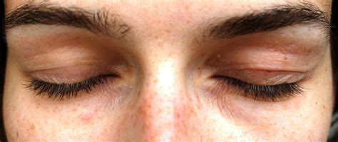Eyelid Eczema Pictures Photos