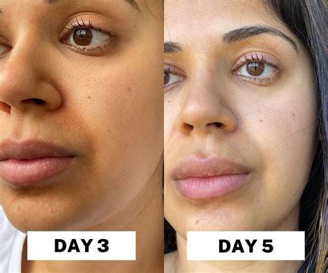 Exactly How I Fixed My Destroyed Skin Barrier In A Week