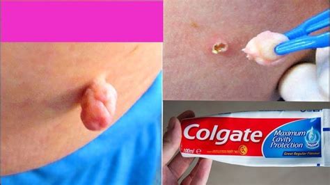And this send signals to the immune system which then sends white blood cells to affected parts while the removal and the healing. How To Remove Skin Tags Naturally | 5 Effective Ways to ...