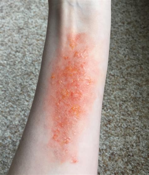 What Kills Poison Ivy Rash On Skin