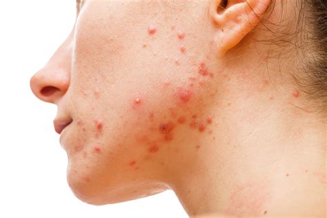 4 Signs You Are Experiencing Hormonal Acne Dermablue