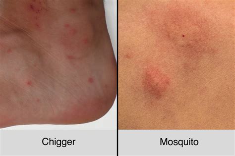 Chigger Bites Vs Mosquito Bites How To Tell The Difference The Healthy
