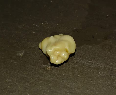 Tonsil Stone Pics On Twitter Personal Tonsilstone From 1082019