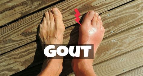 Ibu jari kaki merupakan yang paling besar berkemungkinan mengalami cagu. Gout: Punca, Rawatan dan Cara untuk Mengelakkannya
