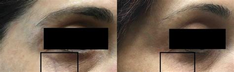 cutera laser before and after photo gallery washington dc mi skin dermatology center melda