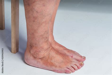 Varicose Veins In An Elderly Woman Inflamed Dilated Veins In The Legs