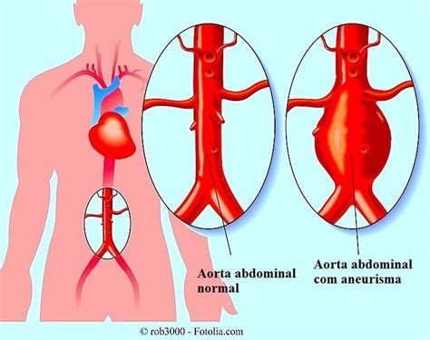 What Is Dissecting Aneurysm Of The Aortaprognosis And Treatment