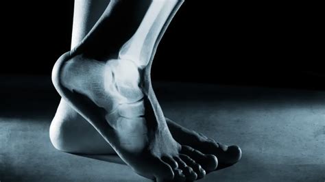 Minimally Invasive Foot And Ankle Surgery At Penn Orthopaedics Mifoot