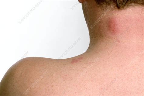 Shingles Rash On The Skin Stock Image C0142426 Science Photo Library