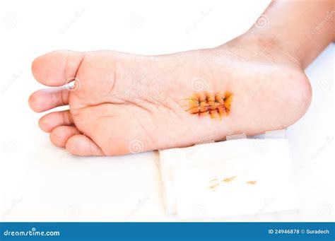 Wound On The Feet Royalty Free Stock Photos Image 24946878
