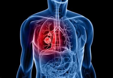 Immunotherapy Plus Radiotherapy Benefits Metastatic Lung Cancer