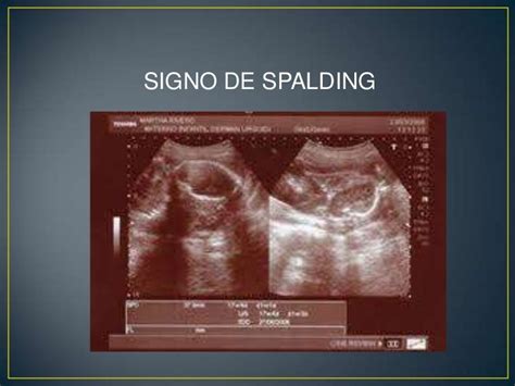 Manejo Del óbito Fetal Intrauterino Cicat Salud