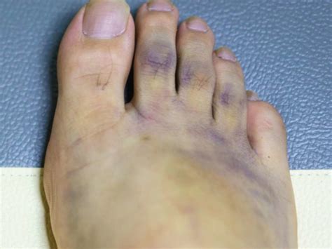 Diabetes Brown Spots On Feet Help Health