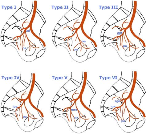 Schematic Diagrams Showing The Variations In Prostatic Artery Origin Download Scientific